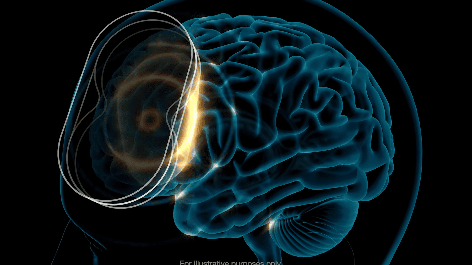 Patient receiving gentle TMS treatment in Houston clinic